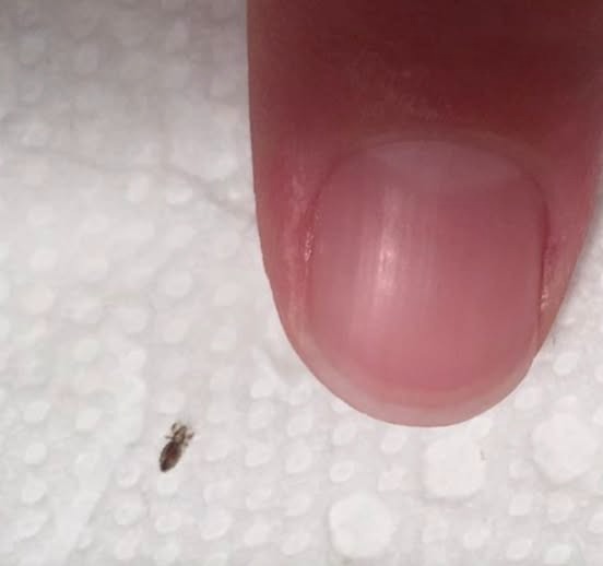 Head lice: How to get rid of them and stop them coming back