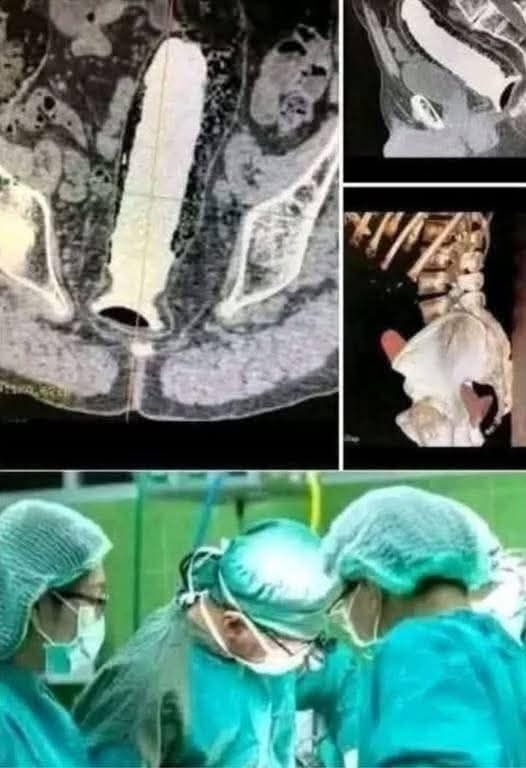 Girl had to be hospitalized for wanting to use a pe…